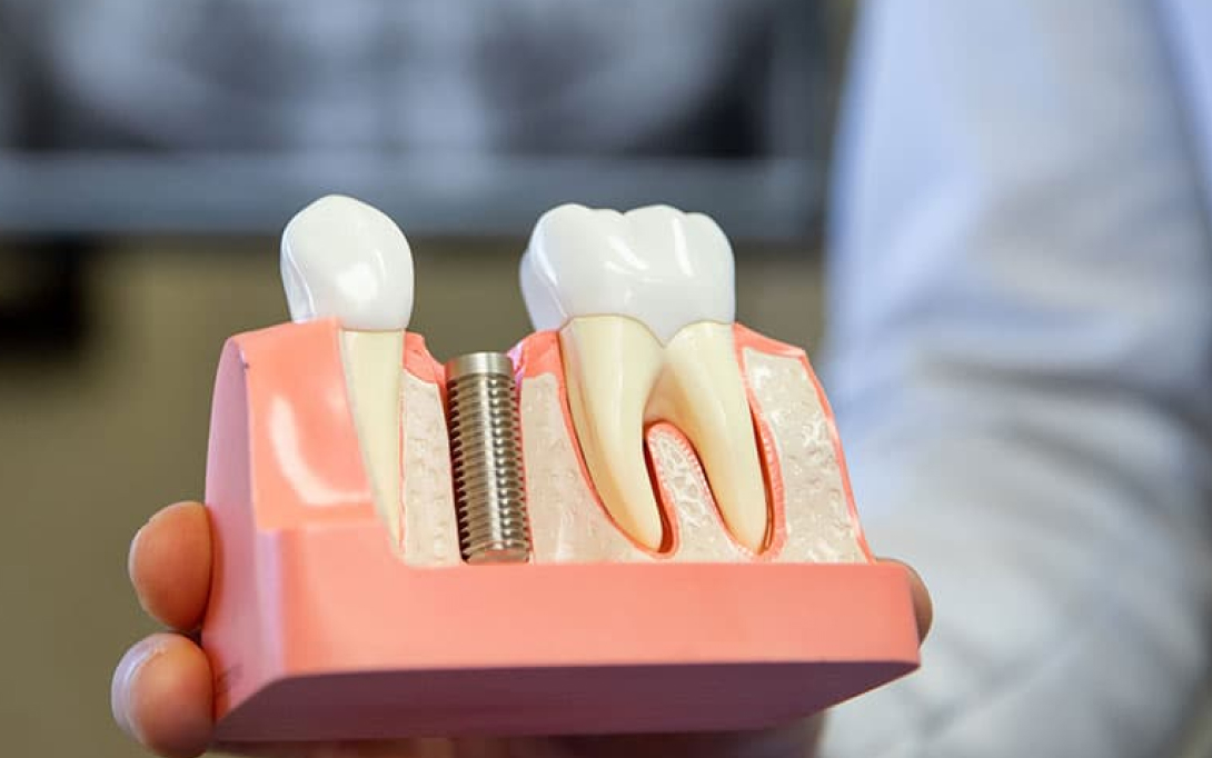 dentist holding model of dental implants
