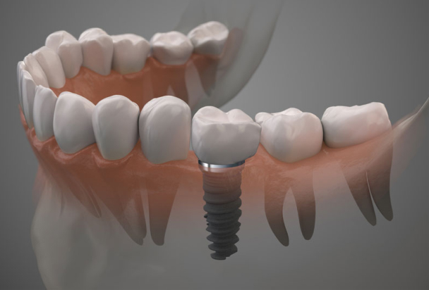 dental implant model