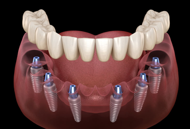 full mouth dental implants