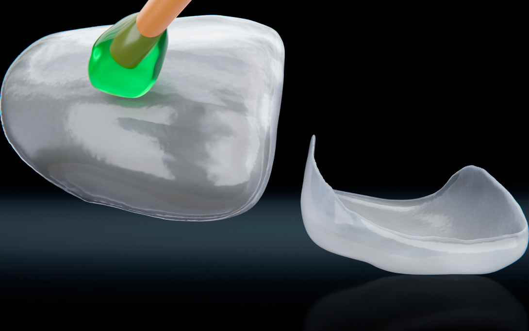 applying glue to veneer onlays