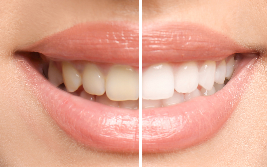 before and after teeth whitening