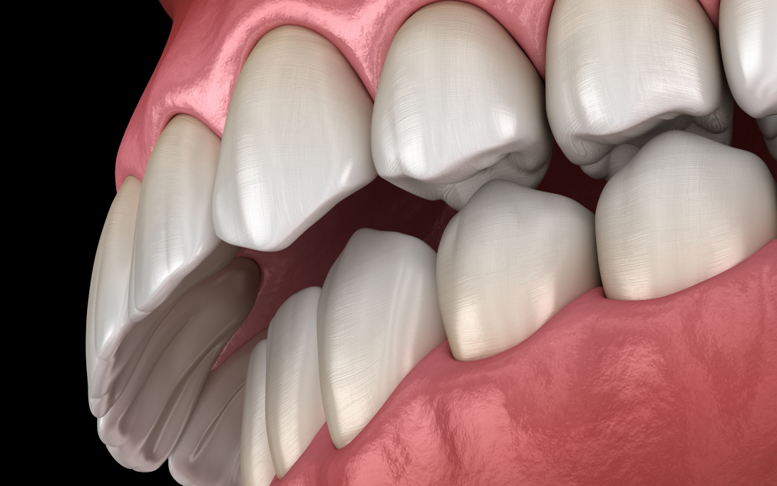 overbite malocclusion 3d render