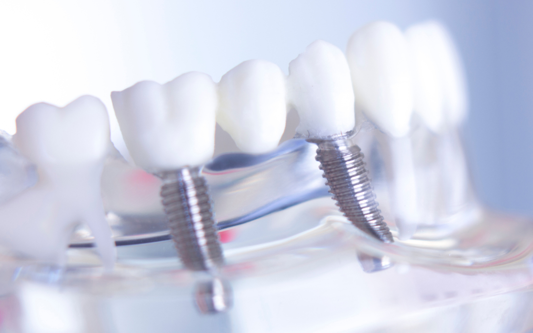 dental implant bridge