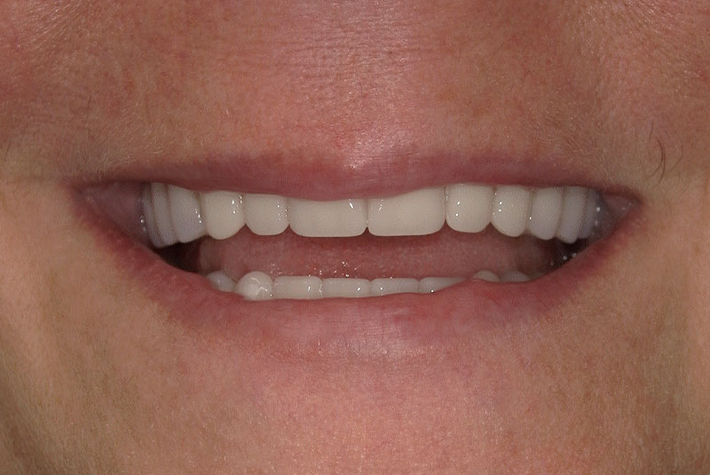 after dental implants
